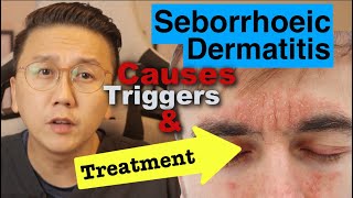 Seborrhoeic Dermatitis  Causes Triggers amp Treatment Options [upl. by Irtimd]