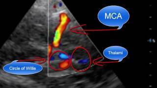 Pointofcare Transcranial Doppler [upl. by Arykat797]