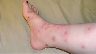 How to Identify an HIV Rash [upl. by Nilac591]