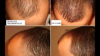 Tratament Păr  Scapă de chelie calviție alopecie Kirkland Minoxidil 5wmv [upl. by Eimam]