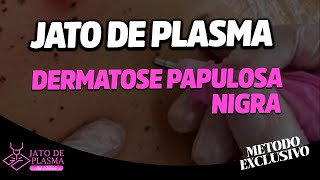 Aula Protocolo exclusivo para Dermatose Papulosa Nigra com Jato de Plasma 100 não invasiva [upl. by Irpac902]