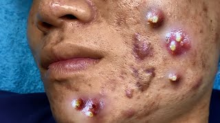 Big Cystic Acne Blackheads Extraction Blackheads amp Milia Whiteheads Removal Pimple Popping 095 [upl. by Georgianne101]