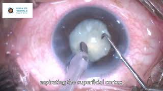 Complicated Mature Cataract  Uveitic Cataract  Dr Ashish K Jain  MEHRC Malad Mumbai [upl. by Hrutkay]