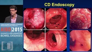 Confirming the Diagnosis Extent and Severity of IBD [upl. by Aylat]