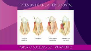 FASES DA DOENÇA PERIODONTAL  O QUE FAZER PARA EVITAR PERDA DE DENTES POR PERIODONTITE [upl. by Bac676]