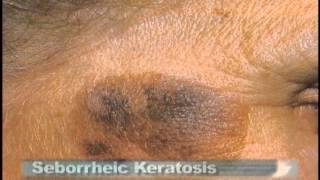 Common Skin Lesions [upl. by Htrow179]