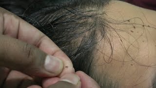 Lice and Nits Picking From Head  KUTO Popping Sounds [upl. by Darin]