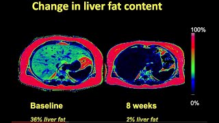 Roy Taylor diabetes lecture fatty liver amp weight loss [upl. by Antipas]