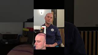 Hair Transplant in Turkey l Hair Transplant Review [upl. by Nosecyrb226]