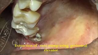 Root stump removal using periosteal elevator [upl. by Hilda]