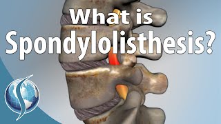 What Is Spondylolisthesis [upl. by Polik]