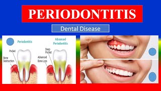 PERIODONTITIS  Definition  types  cusses  Pathophysiology  signs  diagnoses treatment [upl. by Ralfston]