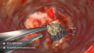 Medical Animation of CO2 Laser Surgery [upl. by Sola752]