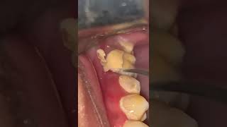 Cleaning and scaling teeth amp tartar amp calculus dentist dental dentista teethcare smileteethcare [upl. by Ogirdor655]