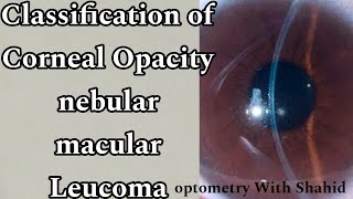 Classification Of Corneal Opacity  Nebular macular Leucoma  Optometry with Shahid [upl. by Fortunio]