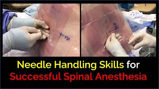 Successful Spinal Anesthesia  Skillful Needle Handling [upl. by Odnumyer608]