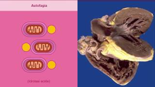 Atrofia metaplasia e displasia [upl. by Nekcerb]