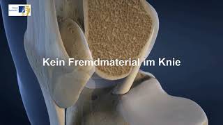 Knie OP bei Kreuzbandriss  3DAnimation Kniegelenk [upl. by Mcquillin]