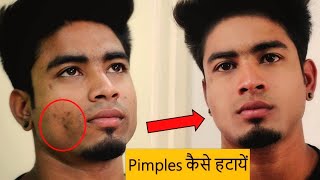 पिम्पल कैसे हटाये How To Remove Pimples  Wow Acne Treatment Kit Review FitnessFighters 2018 [upl. by Price]