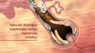 Learn how Demodex mites cause blepharitis [upl. by Davenport]