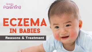 Baby Eczema  Causes Signs and Treatment [upl. by Eibmab]