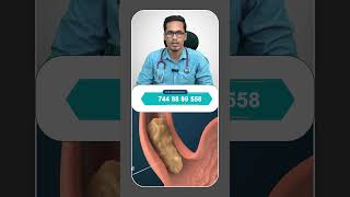 Gastroesophageal Reflux Disease In Tamil GERD shortsfeed trending viralvideo [upl. by Cate648]