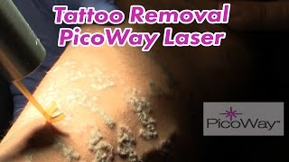 Tattoo Removal with PicoWay Laser System [upl. by Burnside]