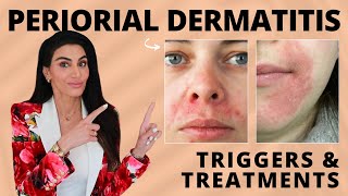 Perioral Dermatitis Triggers amp Treatment Recommendations by a Dermatologist [upl. by Elpmid]