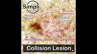 Collision Lesion  MoleNevus and Basal Cell Carcinoma [upl. by Tyler]