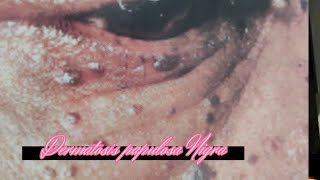 Dermatosis papulosa Nigra skin DPN skincare [upl. by Nylek]