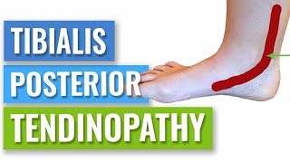 How to Get Rid of Posterior Tibial Tendonitis [upl. by Anirak439]