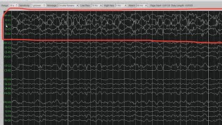 Temporal Lobe Seizure in Sleep [upl. by Acinorrev558]