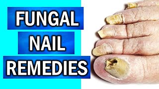 8 EFFECTIVE Home Remedies to Cure Fungal Nail Infections [upl. by Kosey968]