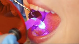 Treatment of caries with the placement of a lightcuring filling doctor dentist [upl. by Gnaig]