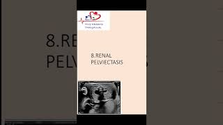 Renal pelviectasis on antenatal scanwhat should we do renalpelviectasis [upl. by Yahsed]