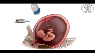 Genetic disorder diagnosis in pregnancy by Amniocentesis amp CVS Chorionic Villus Sampling [upl. by Diet]