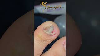 Ingrown Nail Removal [upl. by Sallie847]