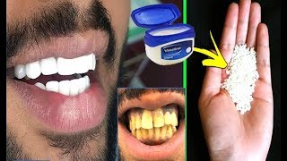 In Just 2 Minutes Turn Yellow Teeth To Pearl White and Shine Teeth Whiten at Home everyday culture [upl. by Worthington]