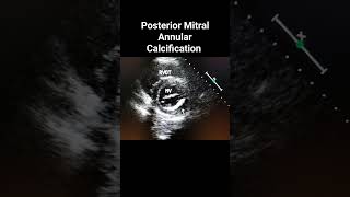 Posterior Mitral Annular Calcification [upl. by Eineg]