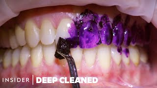 How Teeth Are Professionally Deep Cleaned  Deep Cleaned [upl. by Higgins123]