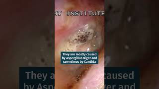 What is a Fungal Ear Infection  Dr K R Meghanadh Medyblog [upl. by Ennis]