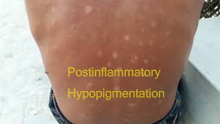 Postinflammatory Hypopigmentation [upl. by Alastair]