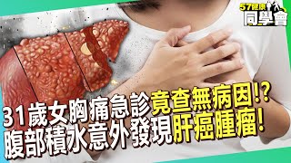 31歲女胸痛急診「竟查無病因」？！腹部積水意外發現「肝癌腫瘤」醫師直呼：運氣好！【 57healthy 】張振榕 醫師 [upl. by Hau]