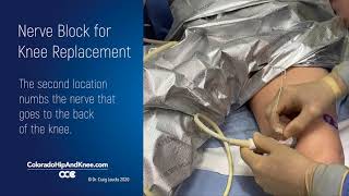 Nerve Block for Total Knee Replacement [upl. by Ayikal483]