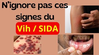 Quels sont les 13 signes du VIH  SIDA [upl. by Navillus]