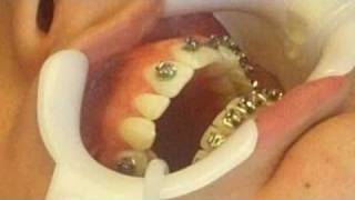 Orthodontist Places Braces on PatientSee how easy it is to get braces [upl. by Wake]