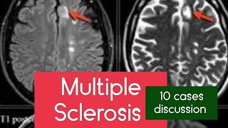 Multiple sclerosis on MRI and CTScan imaging radiology learning mri multiplesclerosisawareness [upl. by Yllak]