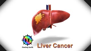 Liver Cancer  Symptom Causes amp Diagnosis Finding Earth [upl. by Mazel]