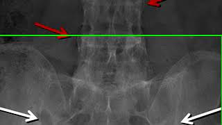 Sacroiliitis Frcr Radiology [upl. by Fishman57]