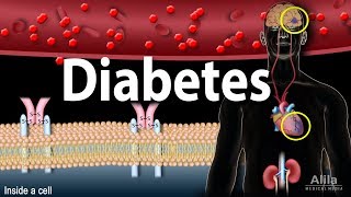 Diabetes mellitus  Symptoms Complication Pathology of Type 1 and Type 2 Animation [upl. by Odracir992]